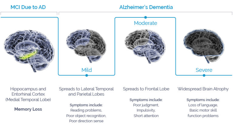 About MCI and Alzheimer’s Dementia - AgeneBio | Developing Innovative ...