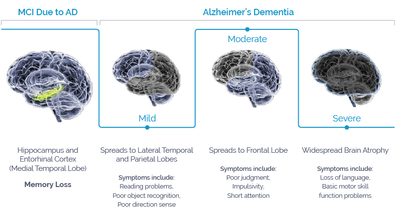Development to Treat Mild Impairment Due to Alzheimer's & Dementia AgeneBio : AgeneBio